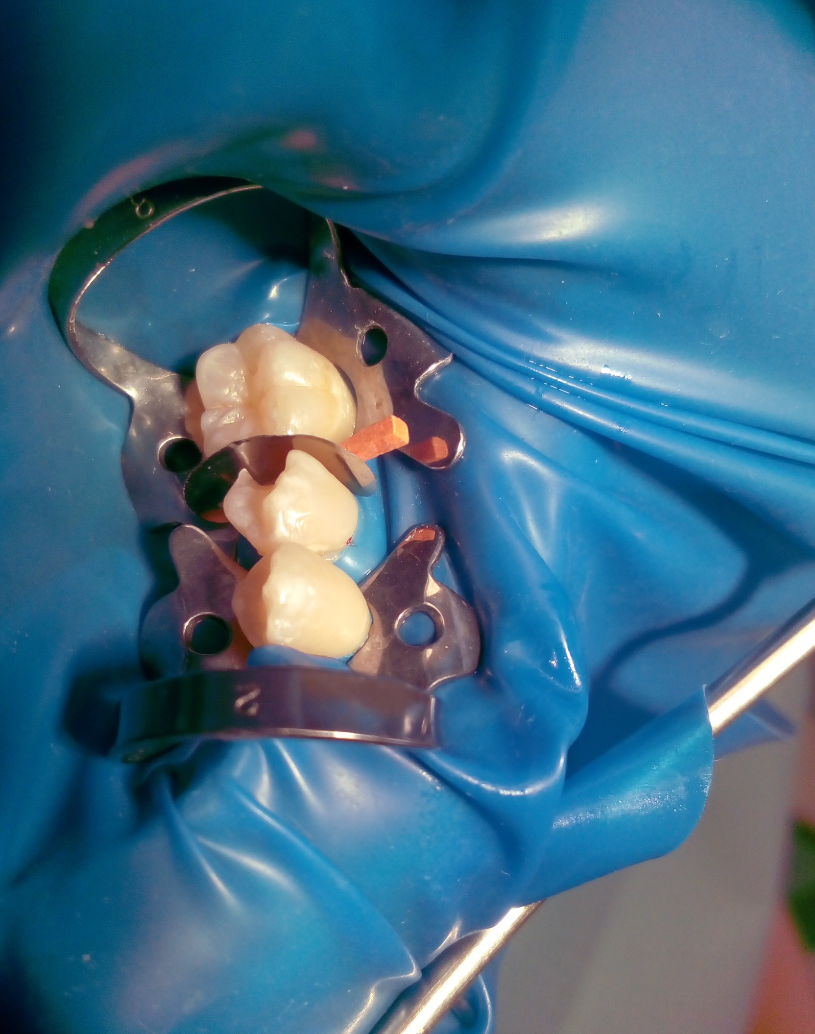 Conservative tooth decay treatment by composite fillings