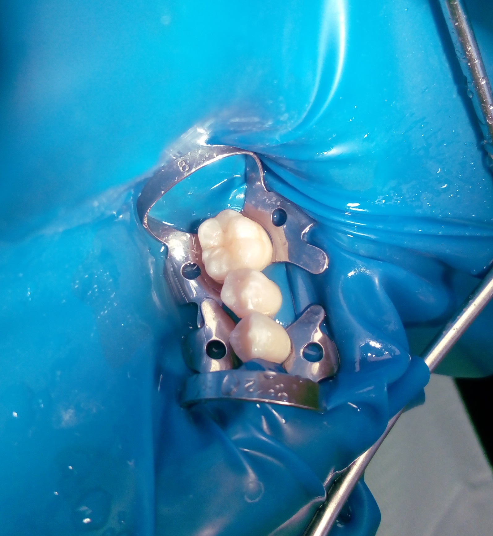 Conservative tooth decay treatment by composite fillings