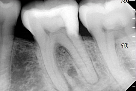 Primary endodontic treatment