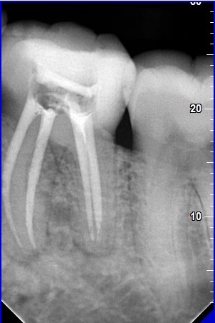 Primary endodontic treatment