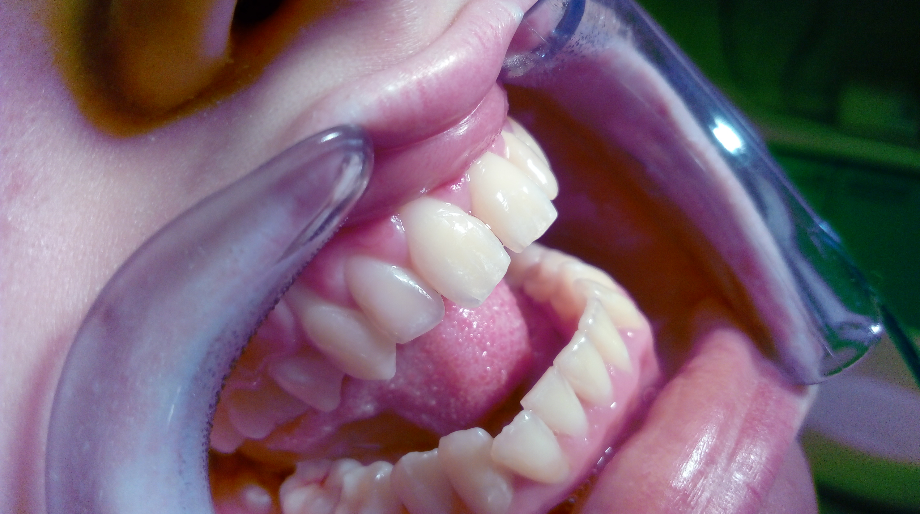 The condition after dental hygiene and frontal teeth treatment by composite fillings